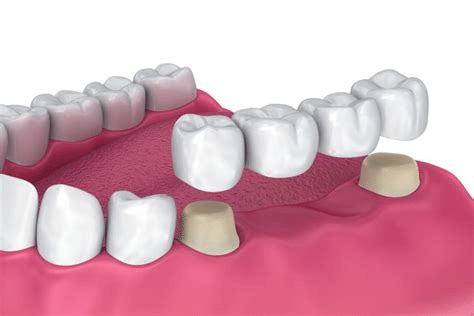 Dental bridge - Dupont Dentistry
