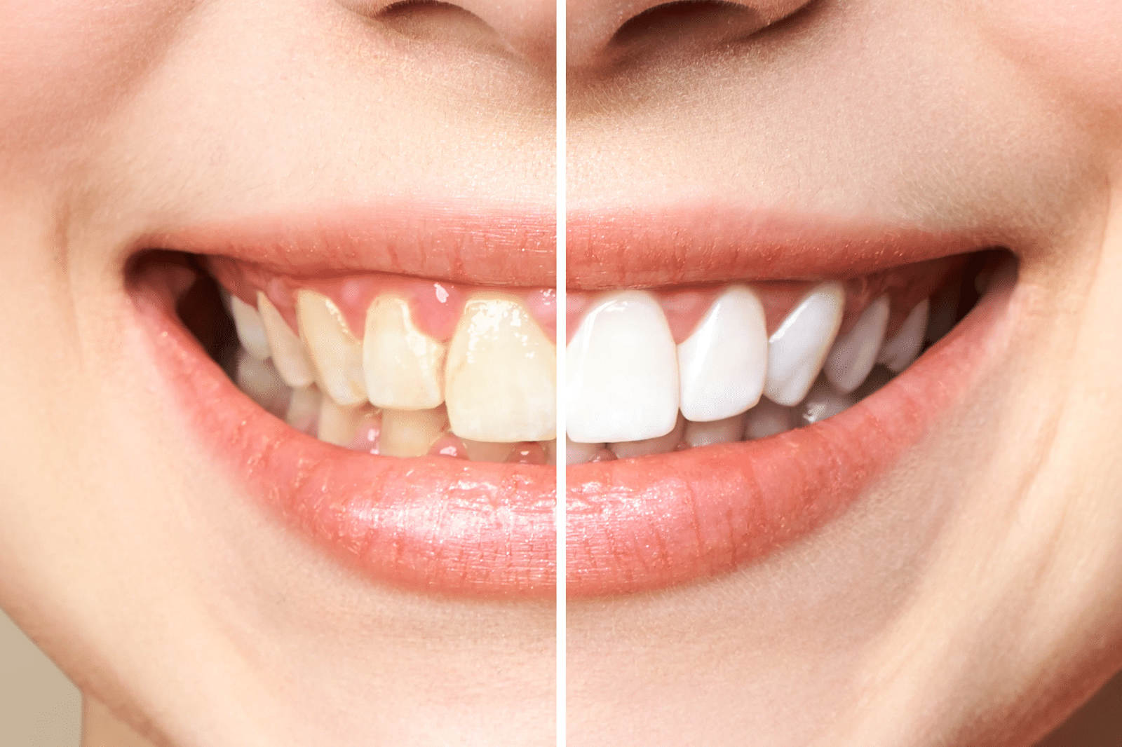 teeth whitening - Dupont Dentistry